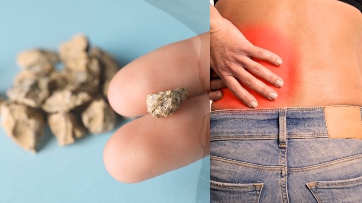 What are kidney stones - it's causes, symptoms and treatment  | O-Lab