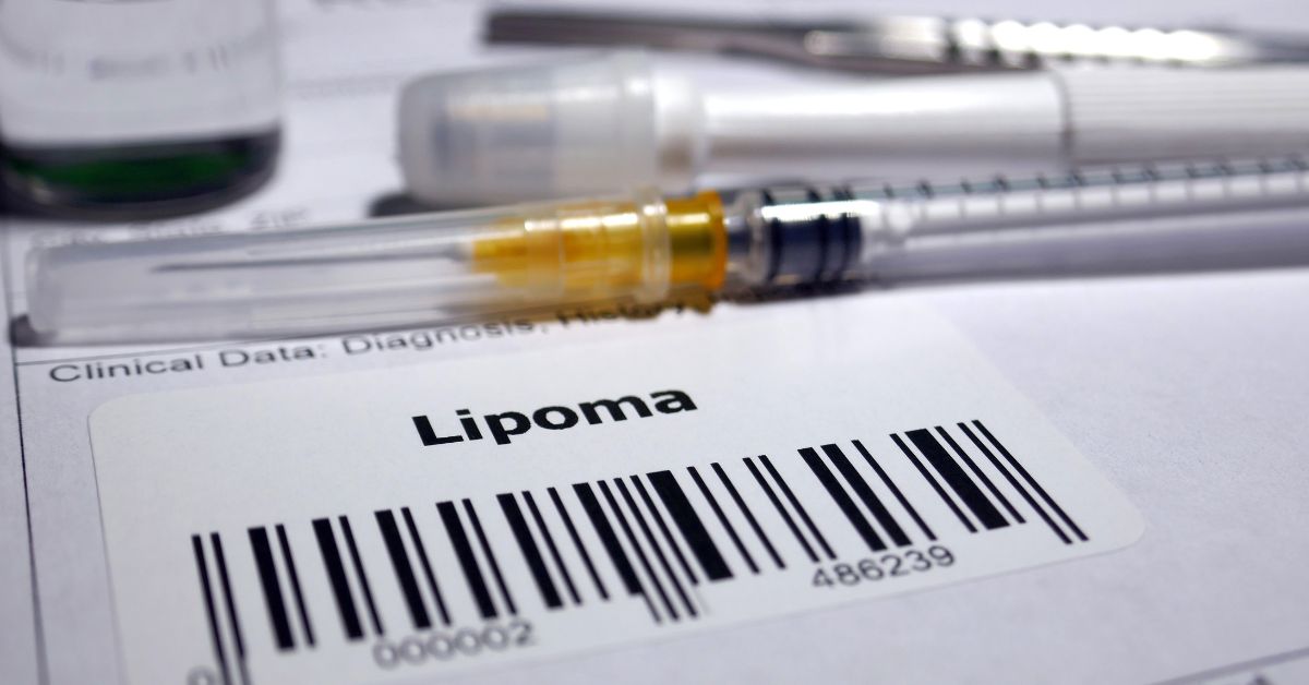 Homeopathic Medicine for Lipoma: Symptoms, Types & Treatment | O-Lab